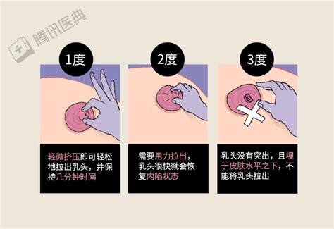 乳暈有毛|你有「乳頭毛」嗎？女性「乳暈毛毛的」可能是嚴重疾病的症狀！。